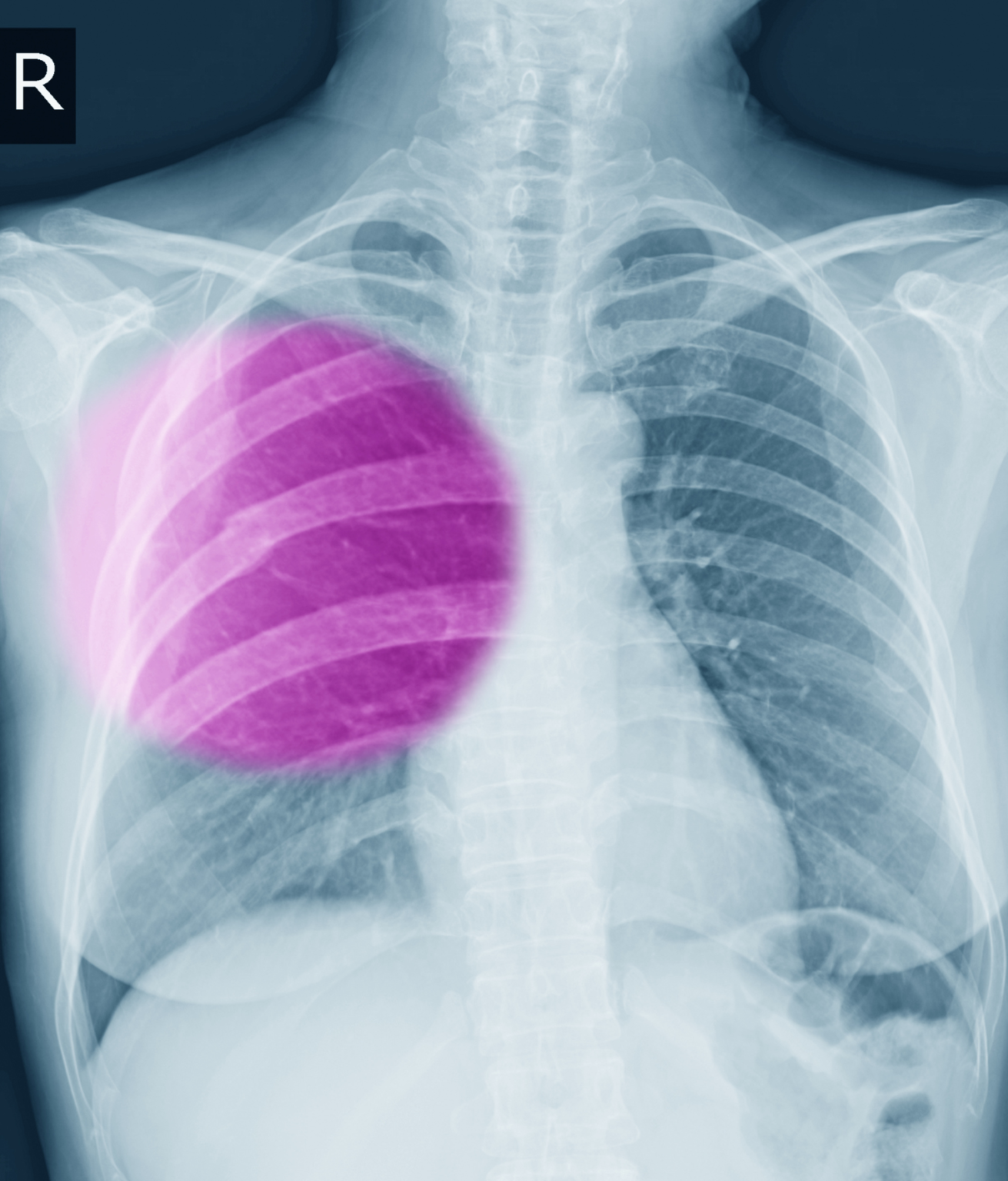 Understanding Rib Fractures: Causes, Types, Symptoms, And Management