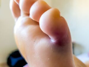 toe swelling