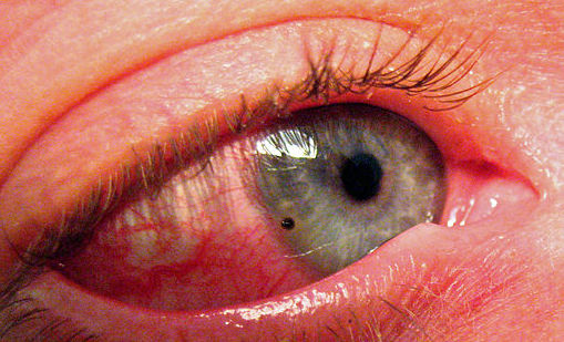 Emergency Eye Clinic Brisbane - Foreign body in eye