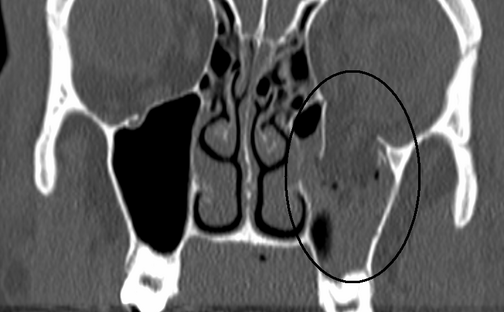 Pblowoutfracture